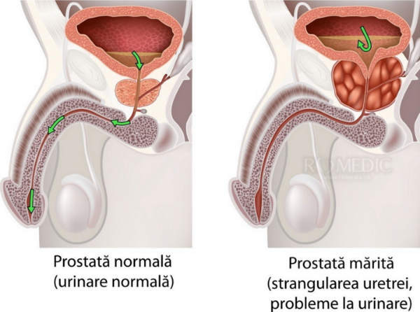 de ce mă doare adesea vezica urinară scade de la pretul prostatitei