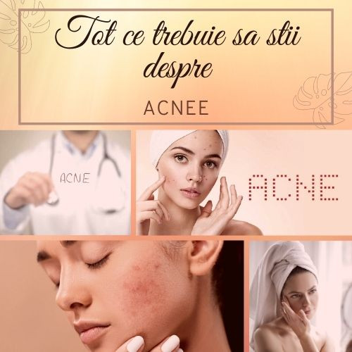 Tot ce trebuie sa stii despre acnee!