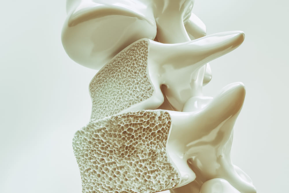 Osteoporoza: cum o poți descoperi la timp