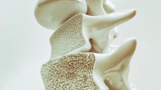 Osteoporoza: cum o poți descoperi la timp