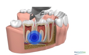 QuickSleeper 6 – Sistem digital pentru anestezie dentară intraosoasă rapidă și fără durere - Img 11