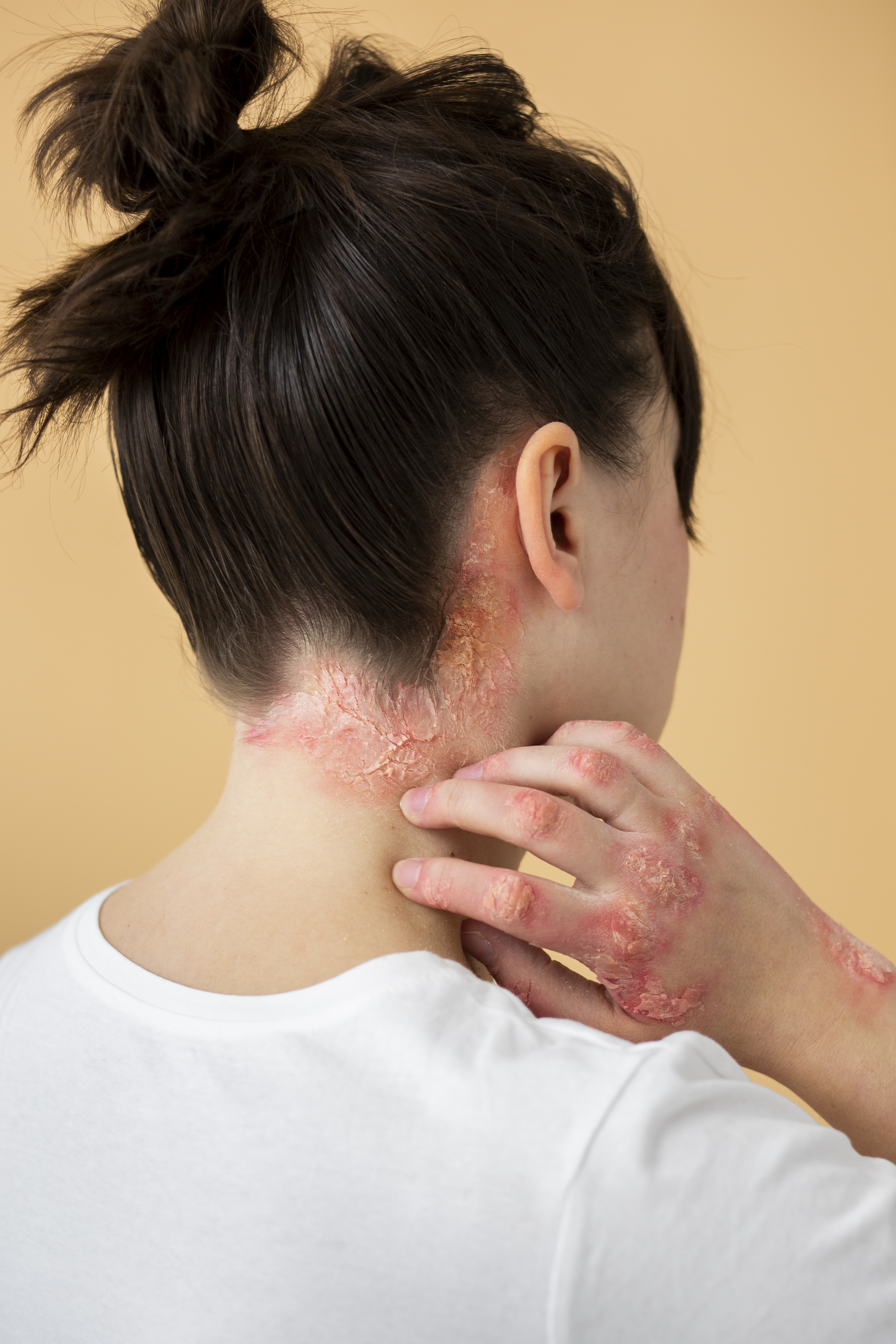 Dermatita seboreică: Cum o recunoști și cum poți îngriji pielea afectată