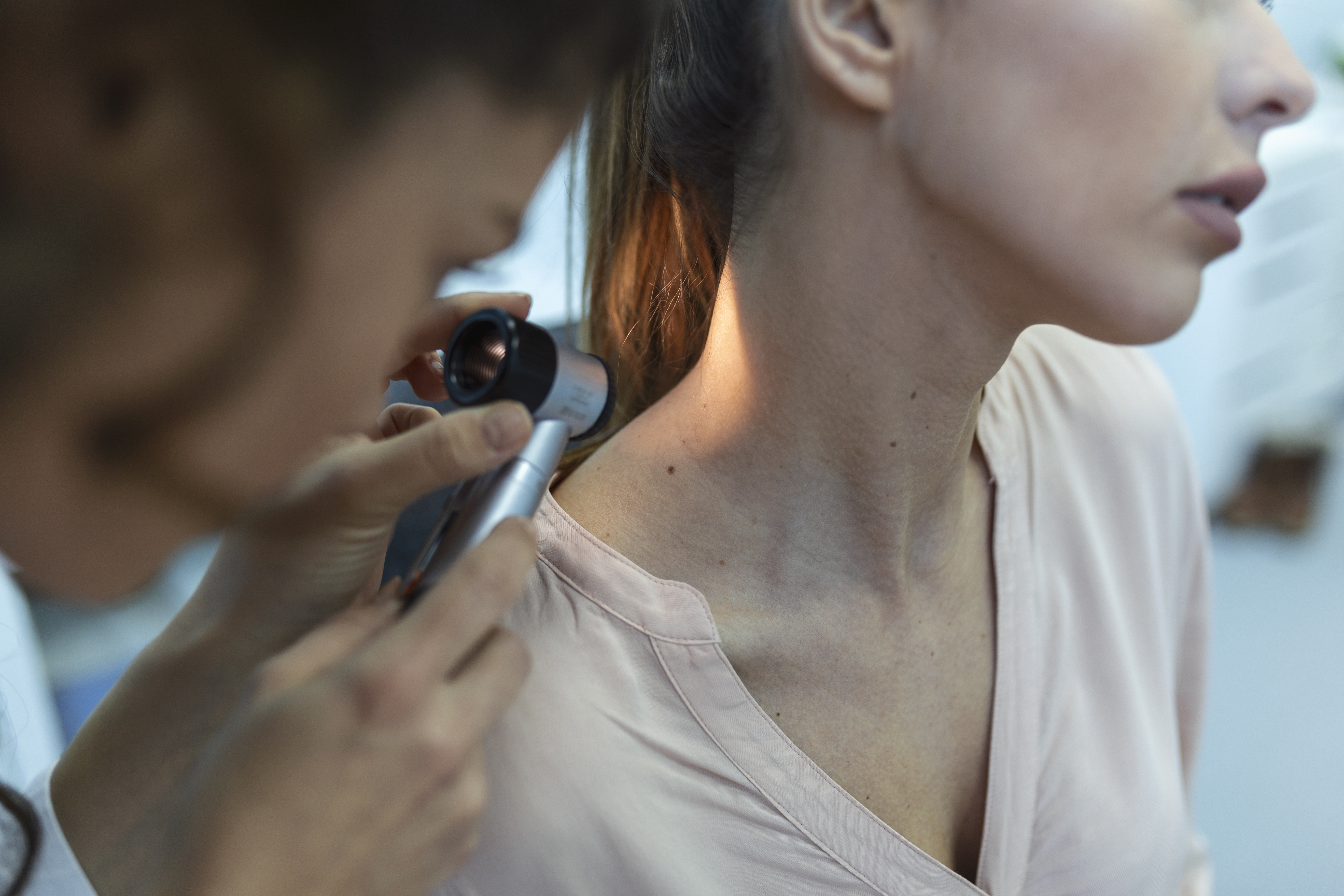 Melanom – Tot ce trebuie să știi: simptome, cauze și prevenție