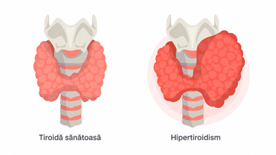 Hipertiroidismul: simptome, cauze, diagnostic și metode de gestionare