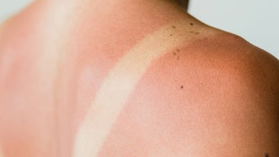 Arsuri solare: cauze, simptome și cele mai eficiente remedii