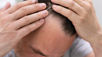 Care e diferența dintre Minoxicapil și minoxidil?