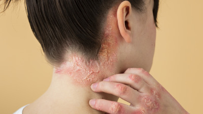 Dermatita seboreică: Cum o recunoști și cum poți îngriji pielea afectată