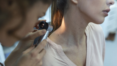 Melanom – Tot ce trebuie să știi: simptome, cauze și prevenție