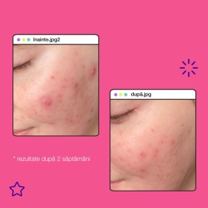 Exfoliant lichid Clear Start CS Breakout Liquid Peel, 30 ml, Dermalogica - Img 4