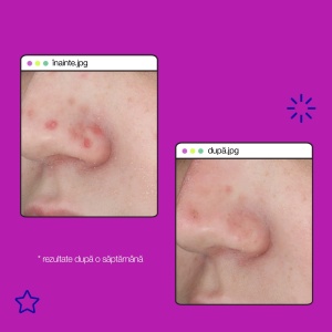 Tratament pentru imperfectiuni Clear Start CS Post Breakout Fix, 15 ml, Dermalogica - Img 6