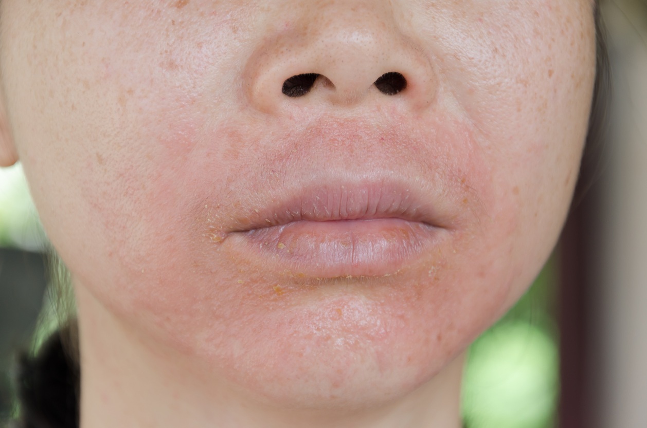 Hidratare și reparare: cum să refaci bariera pielii cu dermatită atopică