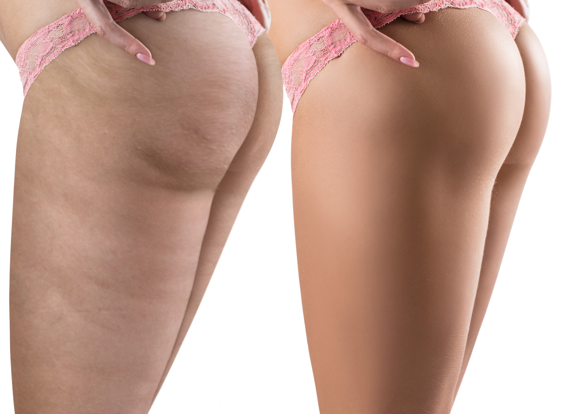 Celulita: Ce este, de ce apare și cum scăpăm de ea