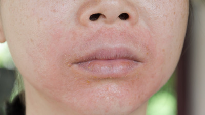 Hidratare și reparare: cum să refaci bariera pielii cu dermatită atopică