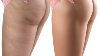 Celulita: Ce este, de ce apare și cum scăpăm de ea