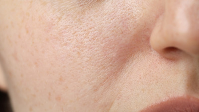 Pori Dilatați + Sebum Excesiv: Ghid Complet 2025 – Cauze, Tratament & Soluții