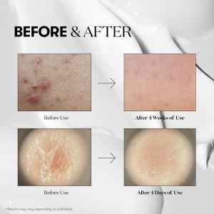 VT Cosmetics - Reedle Shot 100 - Amplificator facial cu micro-ace pentru îmbunătățirea texturii pielii - Img 6