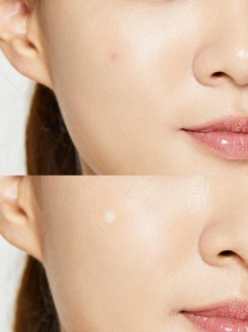 COSRX - AC Collection Acne Patch - Plasturi hidrocoloidali anti acnee pentru tratarea coșurilor - Img 2