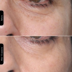 SilkN Facetite Multiplatform ( FTMP1PE1001 )-2