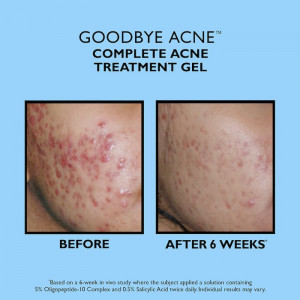 Crema pentru tratarea acneei Peter Thomas Roth Goodbye Acne Complete Acne Treatment Gel, 50 ml - Img 3