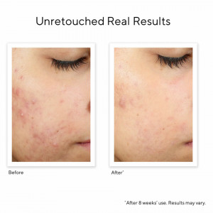 Tratament pentru estomparea si netezirea imperfectiunilor acneice Murad Resurfacing InvisiScar, 15 ml - Img 5