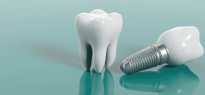 Pot fi implanturile dentare realizate în aceeași zi?