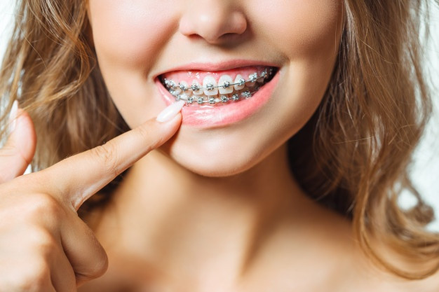 Adulții pot purta aparat dentar?