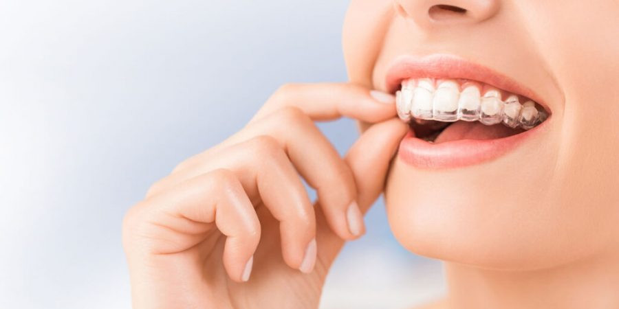 Aparatul dentar Invisalign