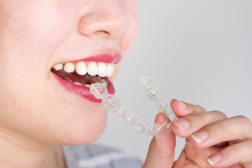 Ce face Invisalign atât de special?