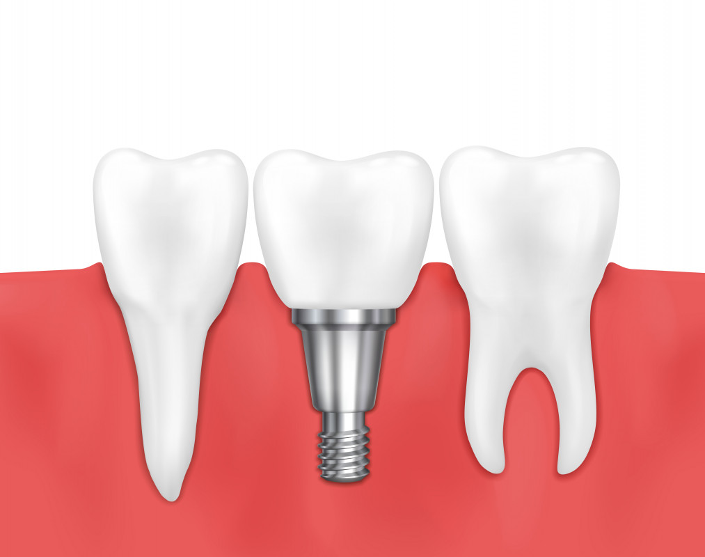 Restaurarea dentară