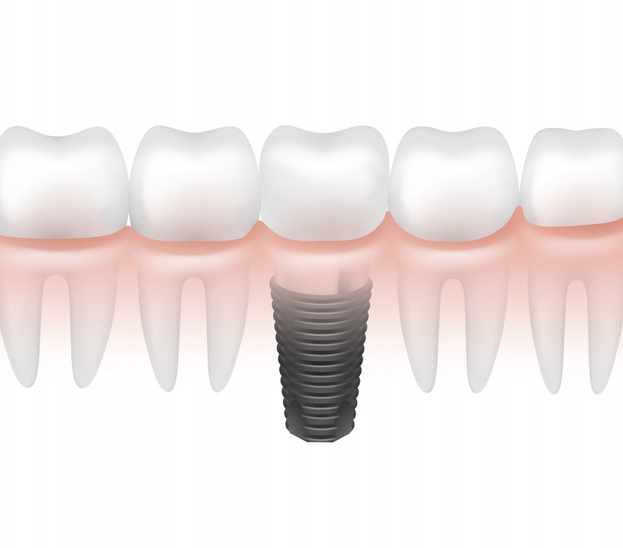 Coroanele dentare