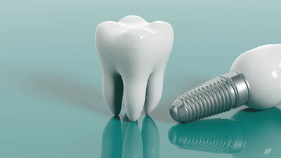 Pot fi implanturile dentare realizate în aceeași zi?