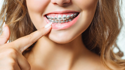 Adulții pot purta aparat dentar?