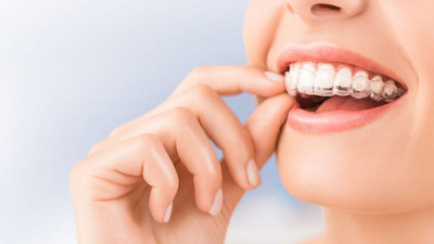 Aparatul dentar Invisalign