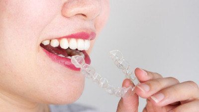 Ce face Invisalign atât de special?
