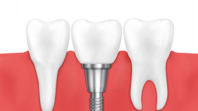 Restaurarea dentară