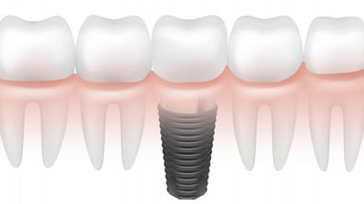 Coroanele dentare
