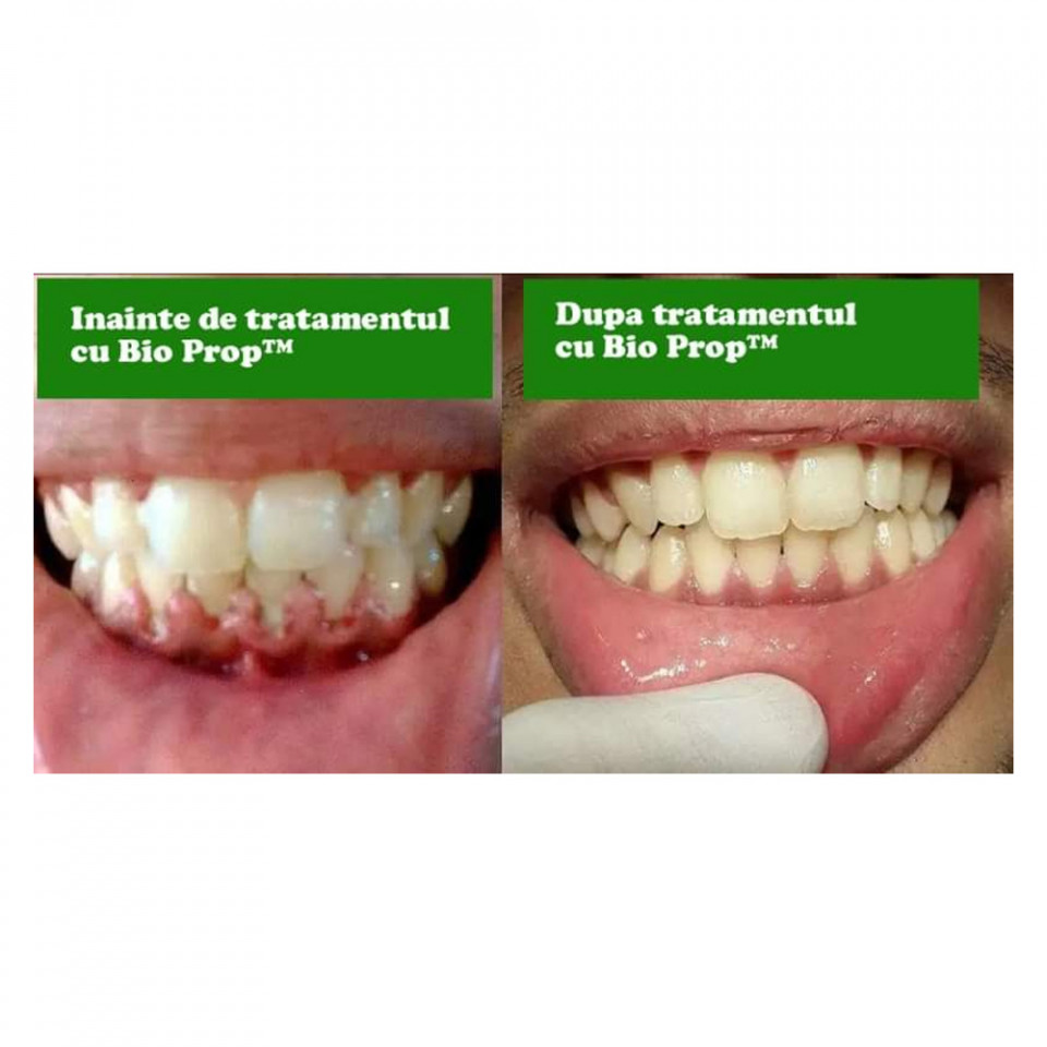 Bio Prop™ - supliment natural pentru preventia parodontozei si igiena - imagine 2