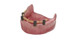 Scanbody Reference | Multiunit - Img 3