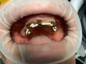 Scanbody Reference | Multiunit - Img 2
