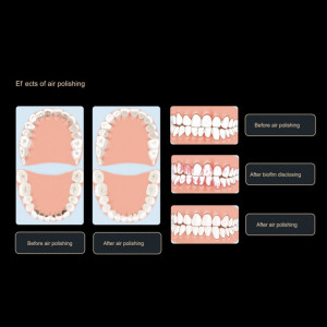 Aparat profilaxie AP-H Plus (supragingival si subgingival) Woodpecker - Img 6