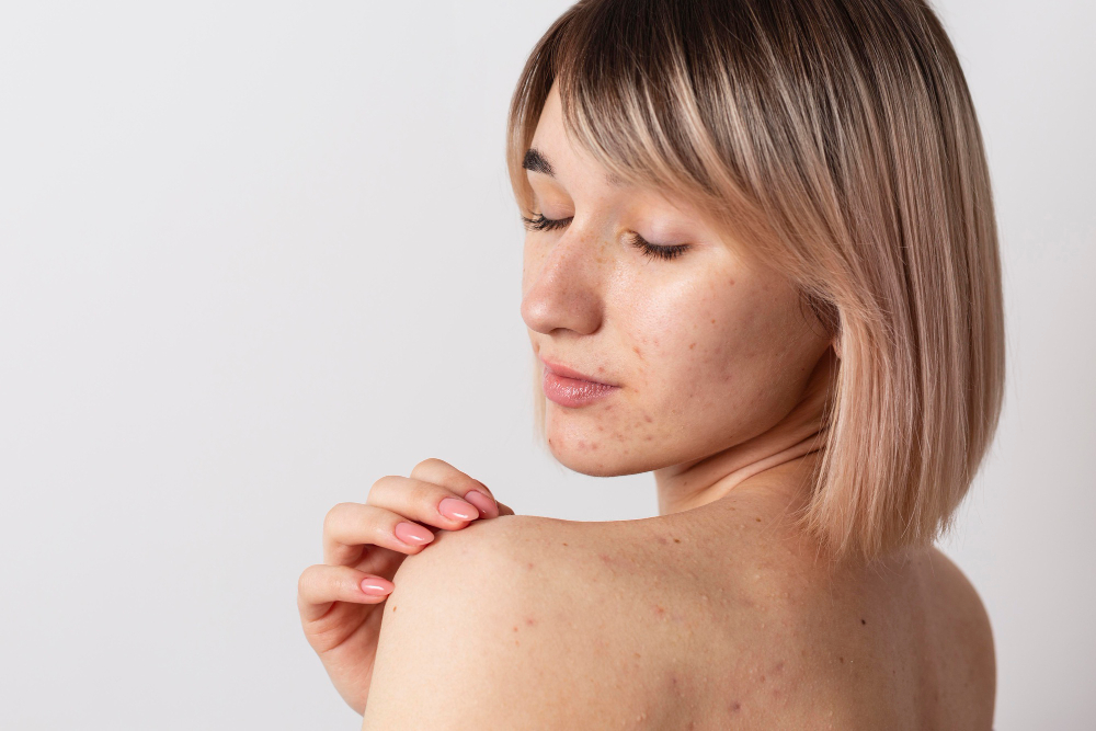 Acneea corporală la adolescenți: de ce apare și cum o putem gestiona