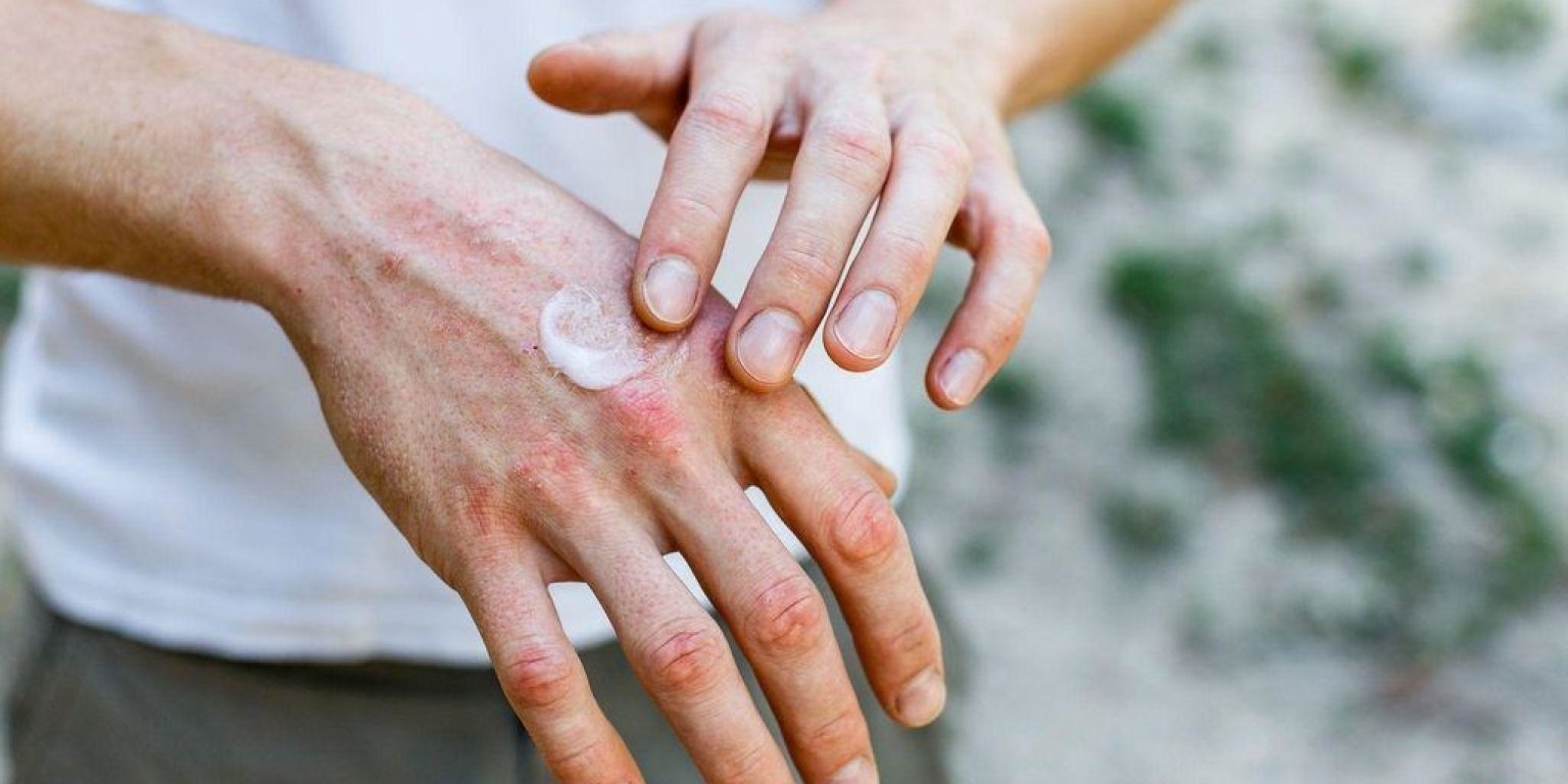 Cum tratăm eczema: soluții clasice și naturale