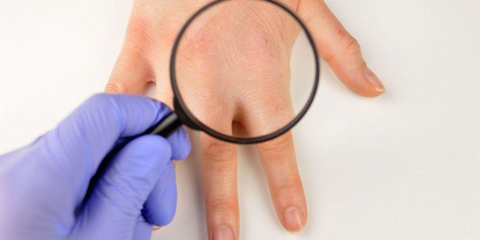 Care sunt diferențele dintre eczemă și psoriazis?