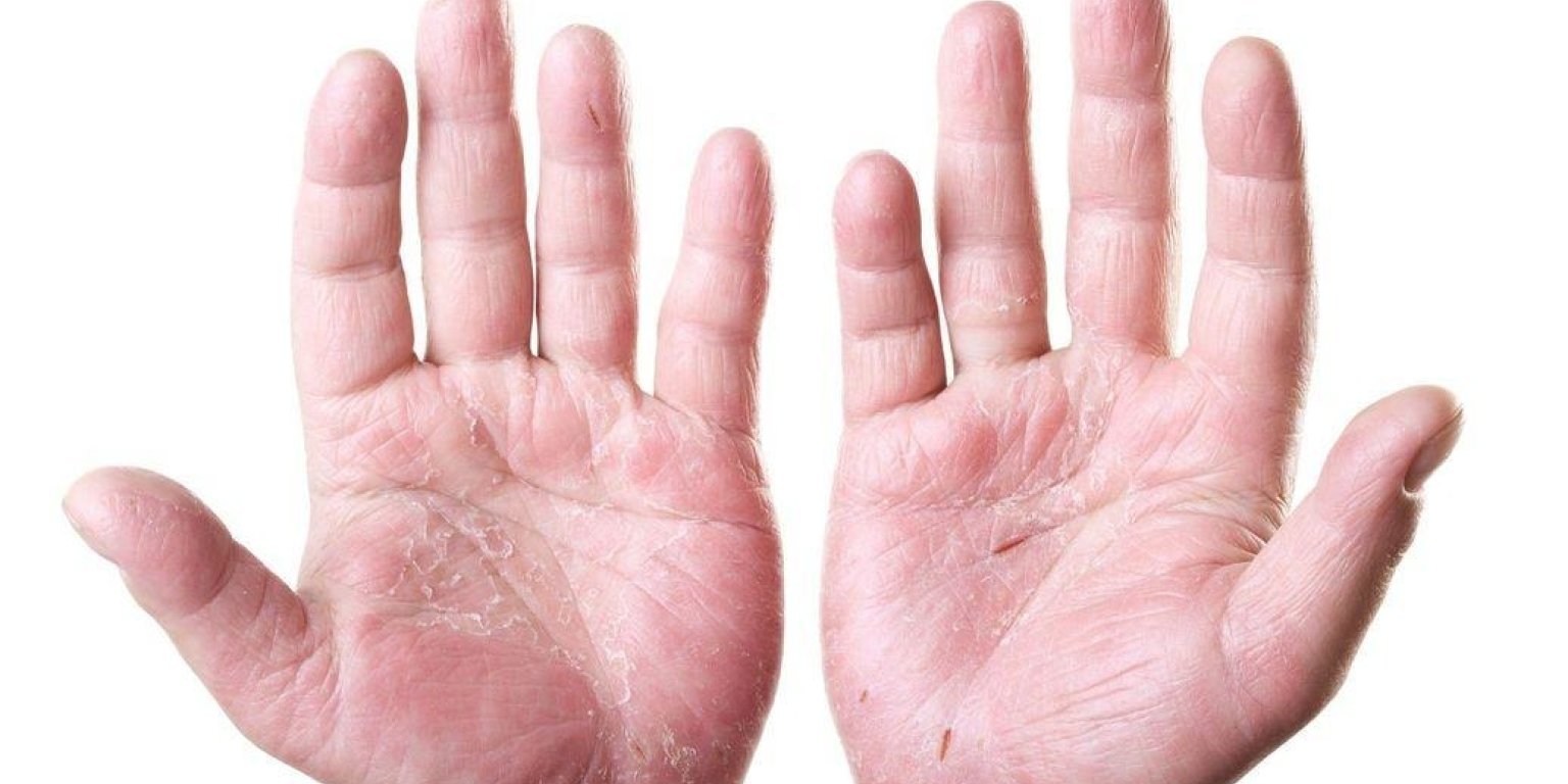 Eczema: cea mai frecventă boală a pielii