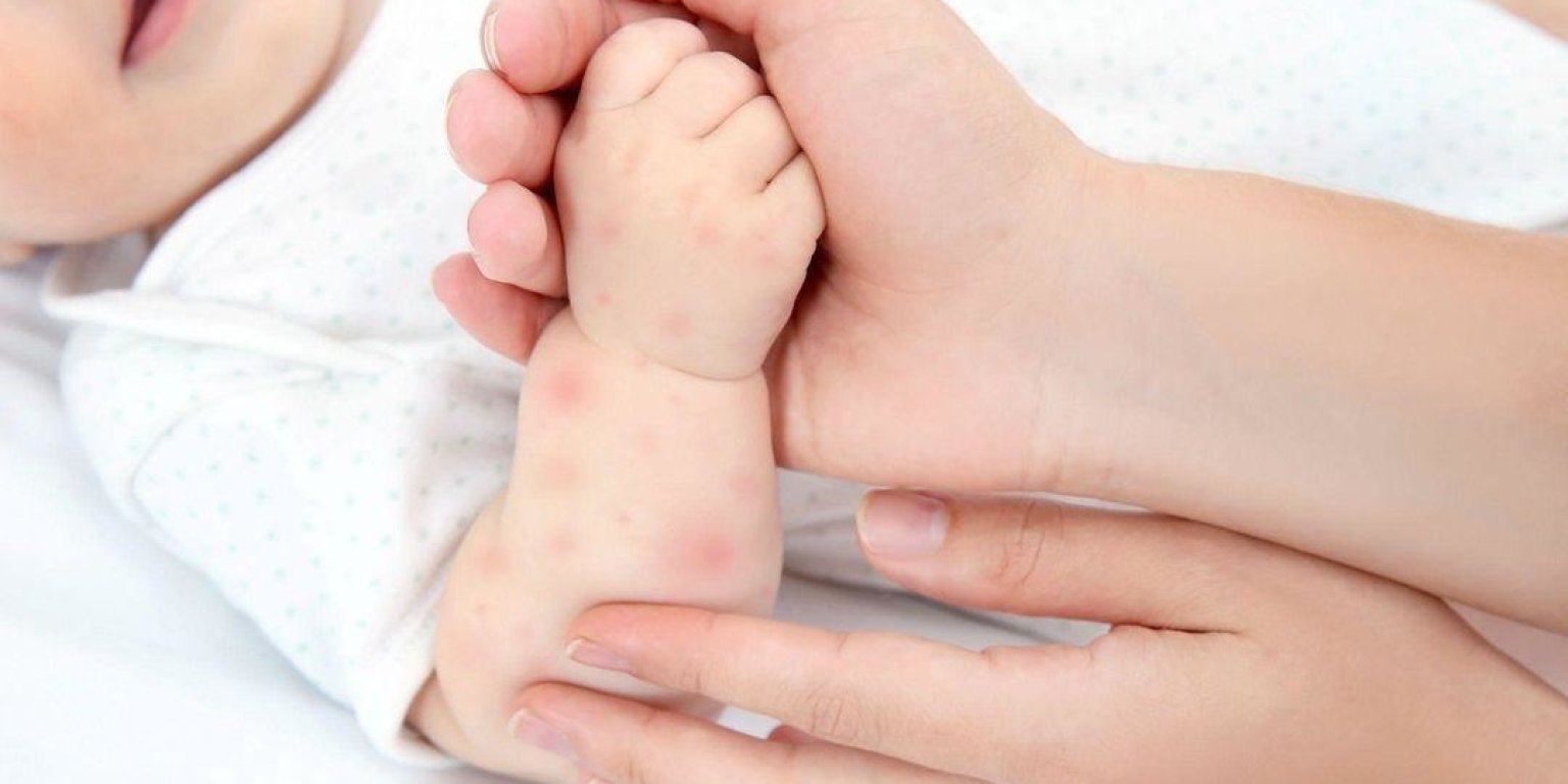 Eczema sugarului: boală benignă care nu trebuie neglijată