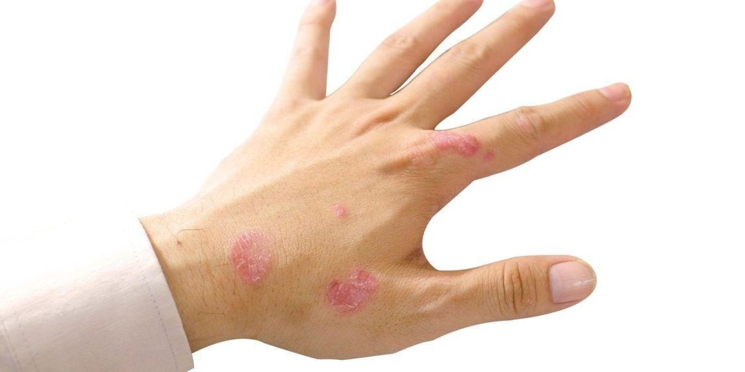 Diferitele forme de psoriazis