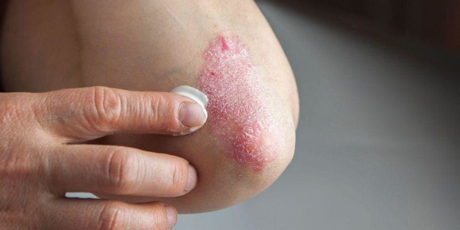 Psoriazisul: tratamente și soluții