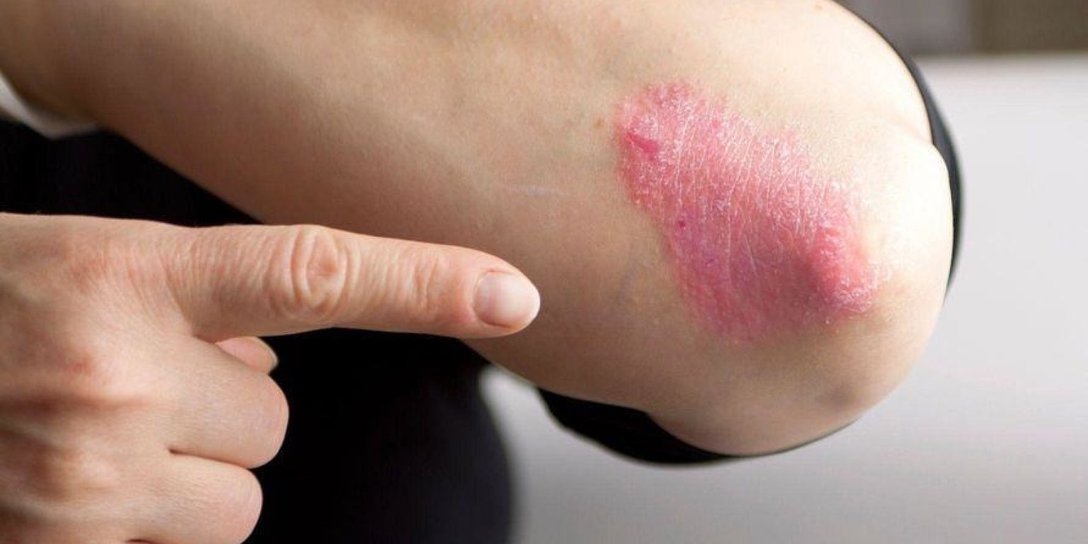 Psoriazisul: o boală cronică a pielii cu origini multiple