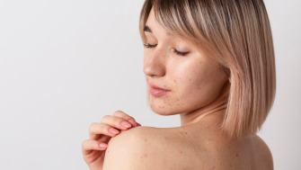 Acneea corporală la adolescenți: de ce apare și cum o putem gestiona
