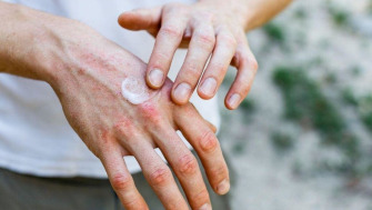 Cum tratăm eczema: soluții clasice și naturale
